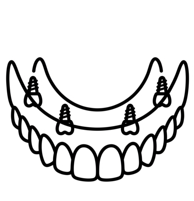 All-on-4 Treatment