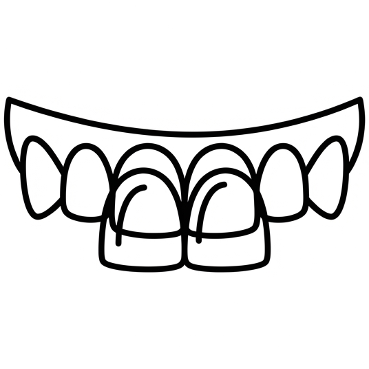 Dental Veneers